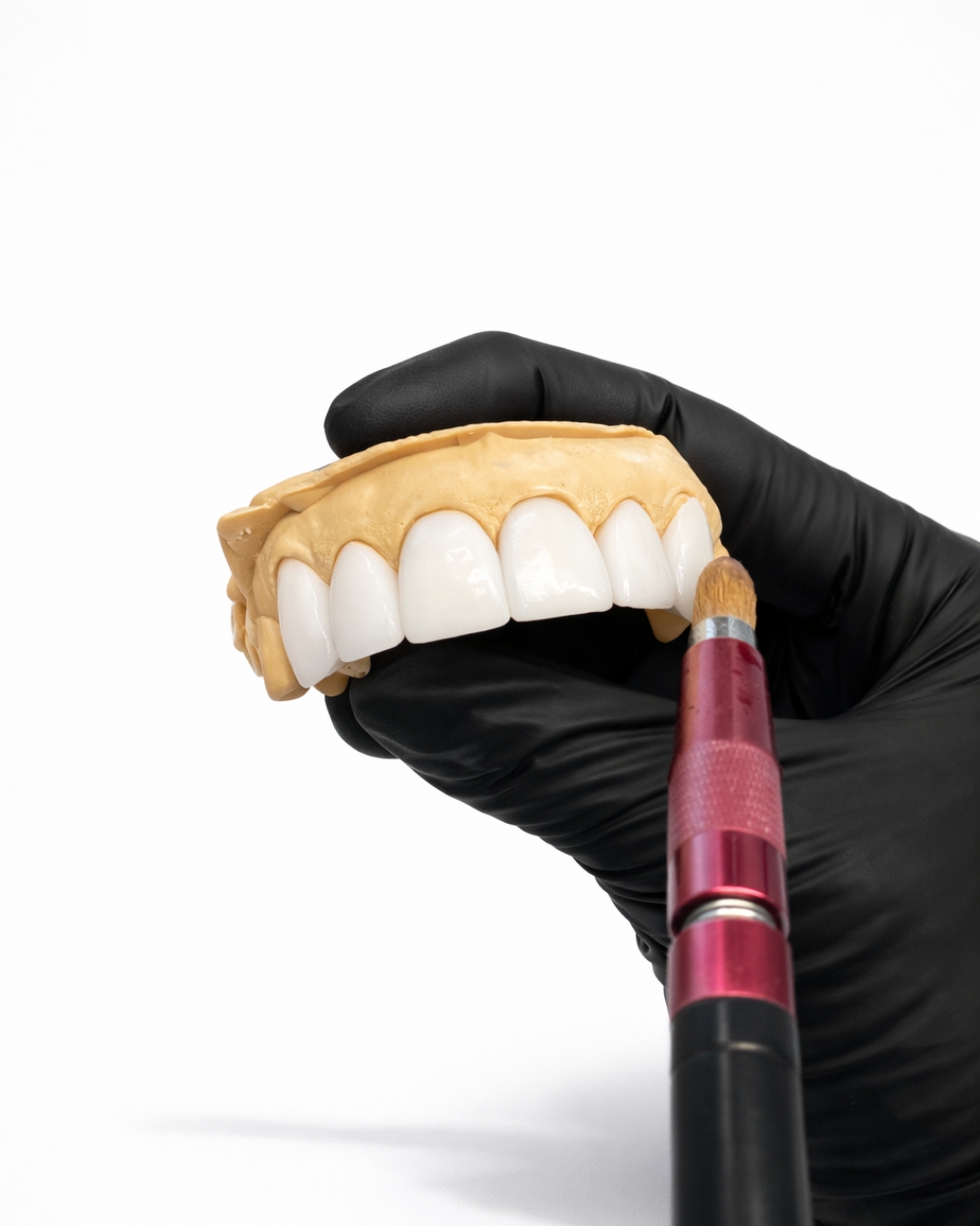 E.max Veneer  -  aesthetics and minimal prep